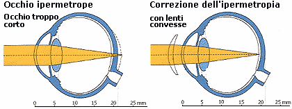 CORREZIONE IPERMETROPIA