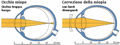 CORREZIONE MIOPIA