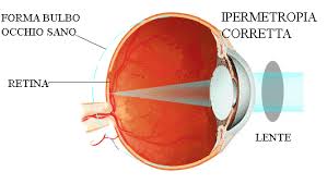 occhio ipermetrope